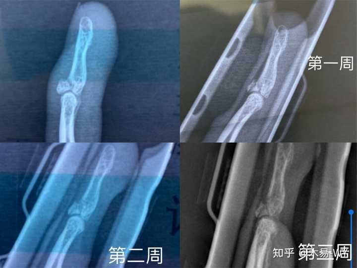 骨头能手指断接好吗图片_手指骨头断了能接好吗_手指断了接骨头多少钱